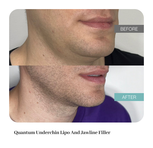 Male Facial Contouring & Liposuction